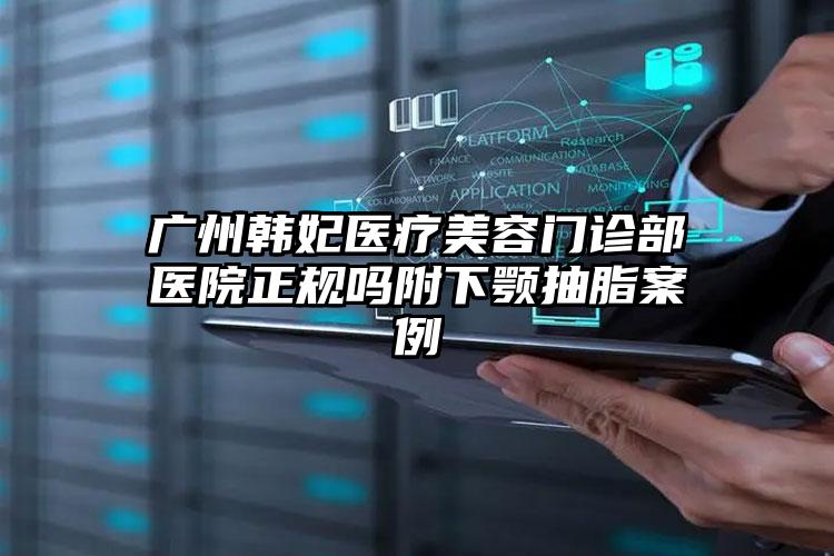 广州韩妃医疗美容门诊部医院正规吗附下颚抽脂案例