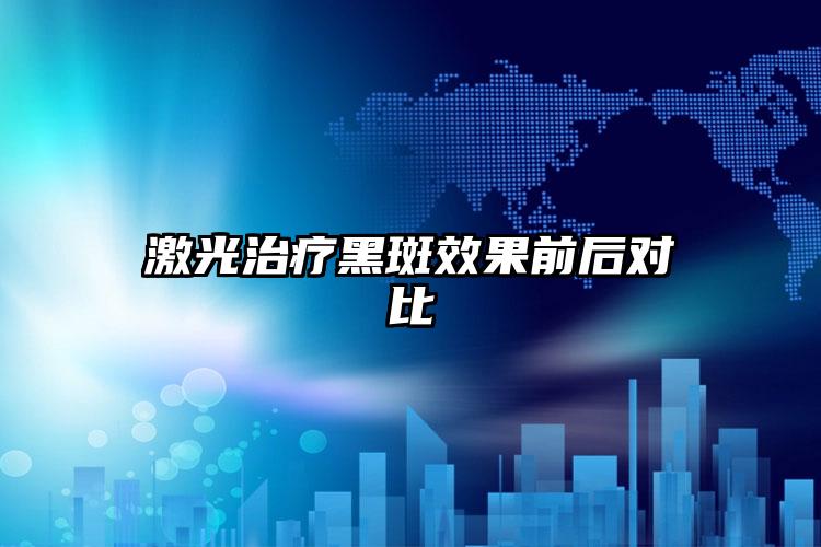 激光治疗黑斑效果前后对比